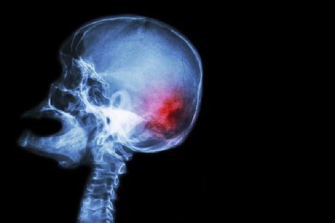 A stroke occurs when there is bleeding or a blockage in a blood vessel caused by a clot. Numerous studies have attempted to draw a link between stress and stroke. - The Straits Times/Asia News Network