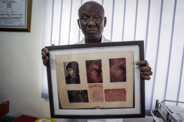 Edmund Delle, dermatologist and founder of Rabito Clinic, at his clinic in Accra on July 2, 2018 holds a picture of a woman with Exogenous Ochronosis, a cutaneous disorder due to a long-term application of hydroquinone skin-lightening beauty products. Africa is experiencing a massive trend of skin bleaching, also called lightening or whitening, particularly in teenagers and young adults. The widening phenomenon is laden with health risks. Every day around 20 patients with skin disorders, because of the long-term use of skin-whitening products, are treated in Rabito Clinic. Edmund Delle is one of the main voices in Ghana against skin-bleaching practise and has helped the government to put in place a national ban of hydroquinone on beauty products. / AFP PHOTO / CRISTINA ALDEHUELA
