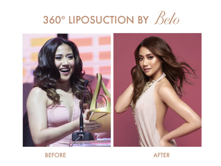 360 Liposuction How It Works and Benefits Lifestyle.INQ
