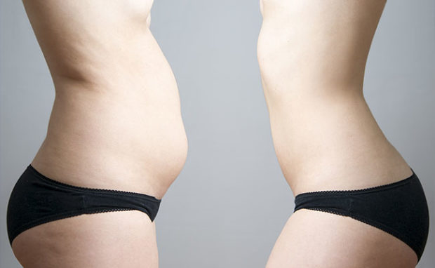 Belo Liposuction vs. Tummy Tuck