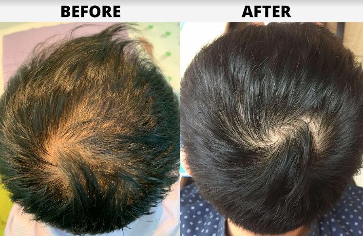 Premier Outpatient Clinic in BGC Offers 30-Minute, Non-Invasive Hair  Regenerative Therapy 