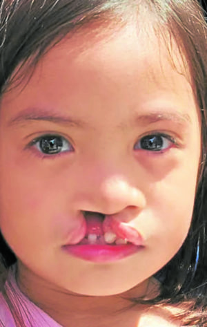 Lucy before the surgical repair of her cleft lip and nasal deformity
