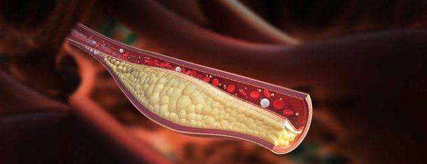 Healthcare professionals discuss importance of ezetimibe in addressing gaps in cholesterol management